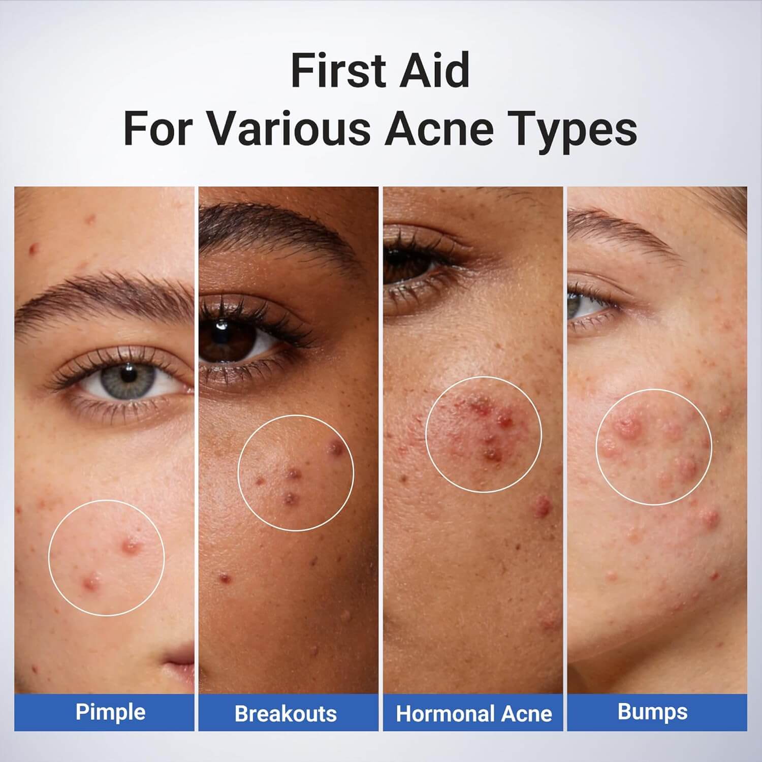 Dr. Leo Salicylic Acid Spot Serum – Acne Treatment with Niacinamide, 0.34 fl oz