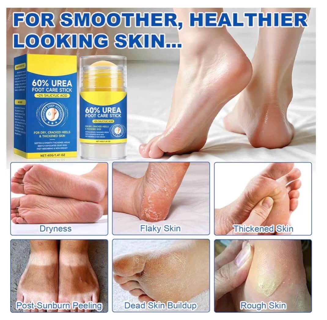 Salicylic Acid Foot Cream – Exfoliating & Hydrating Callus Repair Moisturizer, 3.38 fl oz
