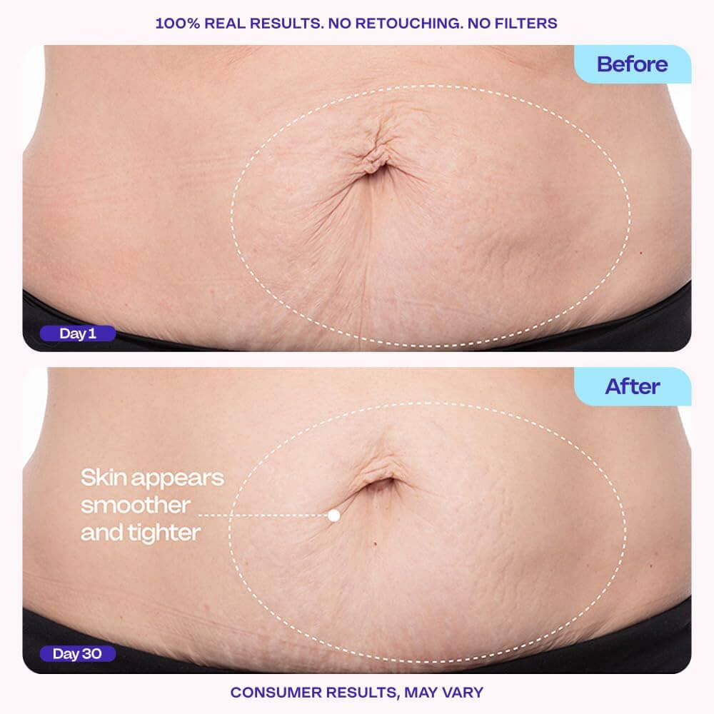 goPure Firming Belly Cream – Skin Tightening & Stretch Mark Body Cream, 4.25 fl oz