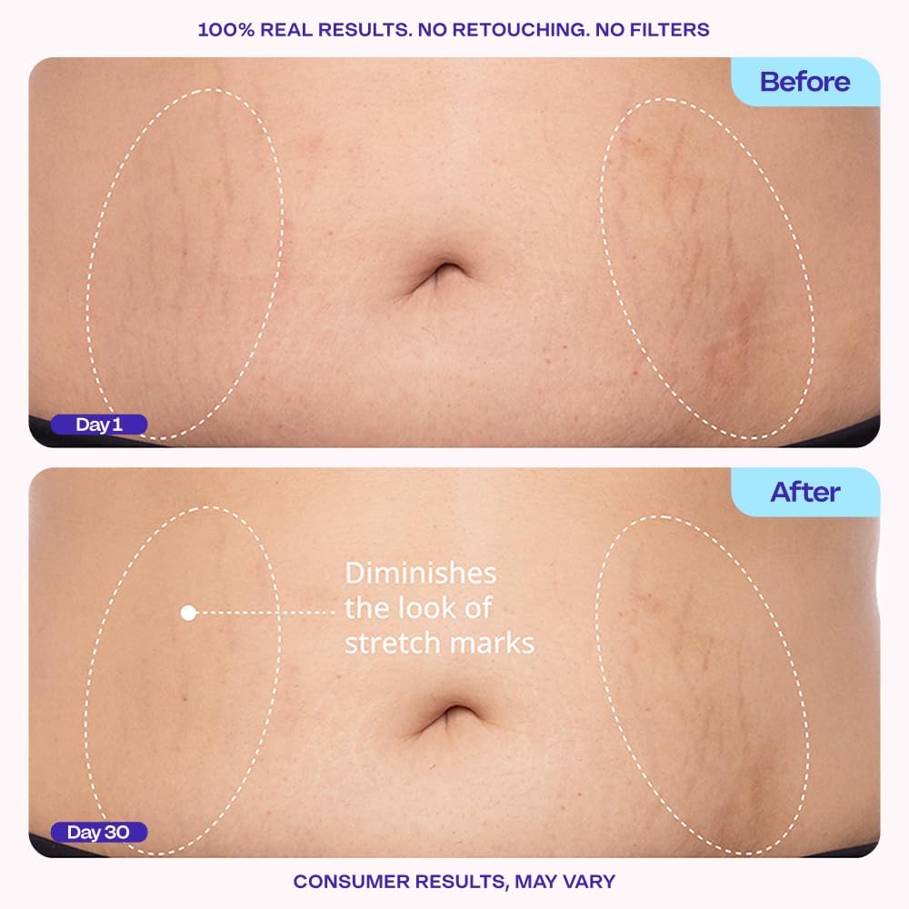 goPure Firming Belly Cream – Skin Tightening & Stretch Mark Body Cream, 4.25 fl oz